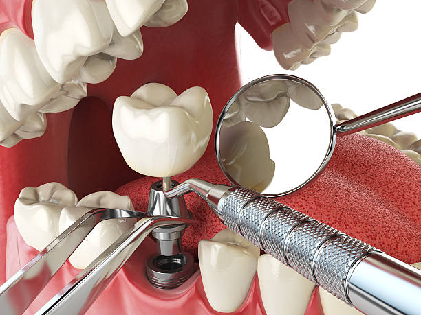 Best Emergency Denture Repair in Peekskill, NY